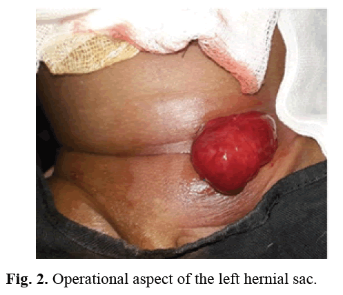 pediatric-hernial