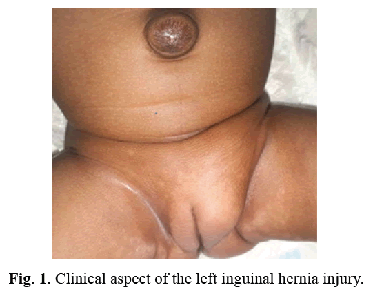 pediatric-inguinal