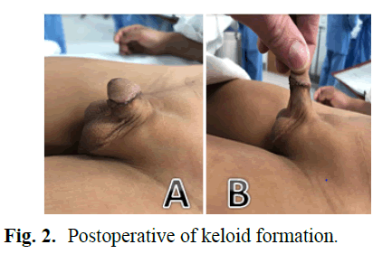 pediatric-keloid