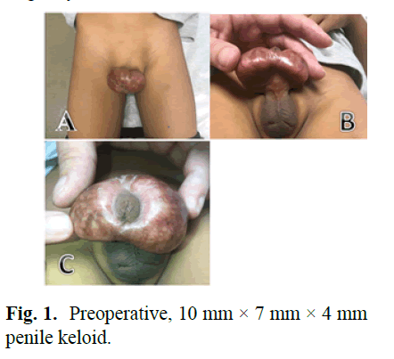 pediatric-penile