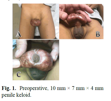 pediatric-penile pediatric-penile