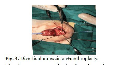 pediatricurology-excision pediatricurology-excision