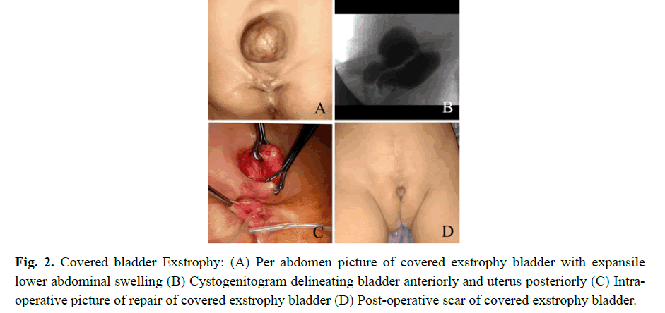 pediatricurology-exstrophy-bladder pediatricurology-exstrophy-bladder