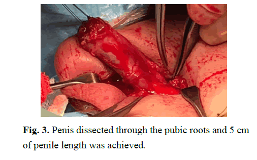 pediatricurology-penile-length