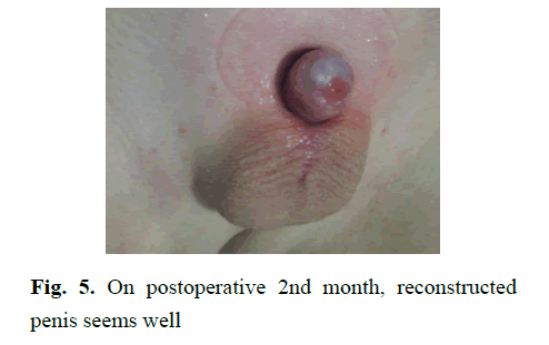pediatricurology-penis-seems