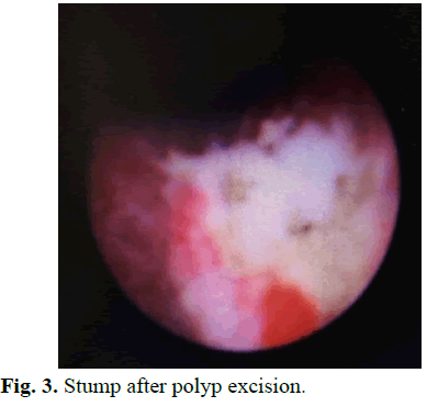 pediatricurology-polyp-excision