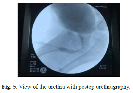 pediatricurology-postop-urethragraphy