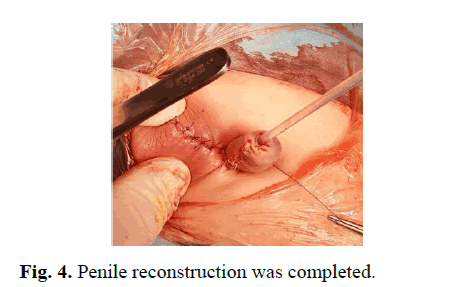 pediatricurology-reconstruction