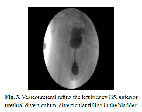 pediatricurology-urethral-diverticulum pediatricurology-urethral-diverticulum