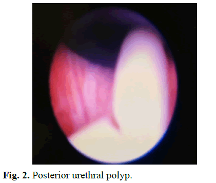 pediatricurology-urethral-polyp pediatricurology-urethral-polyp