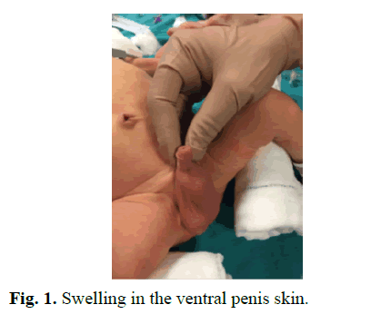 pediatricurology-ventral-penis