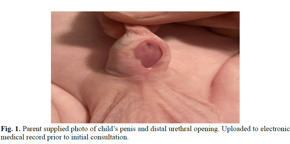 pediatricurology-distal-urethral
