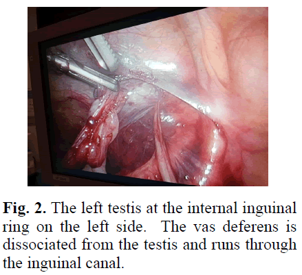 pediatricurology-inguinal