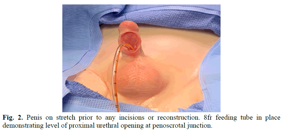 pediatricurology-proximal-urethral