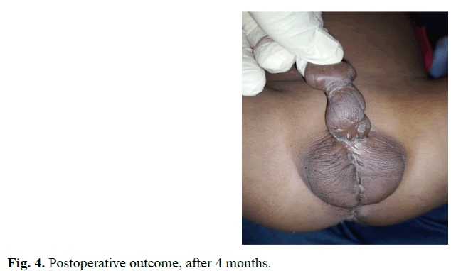 pediatricurology-distal-outcome