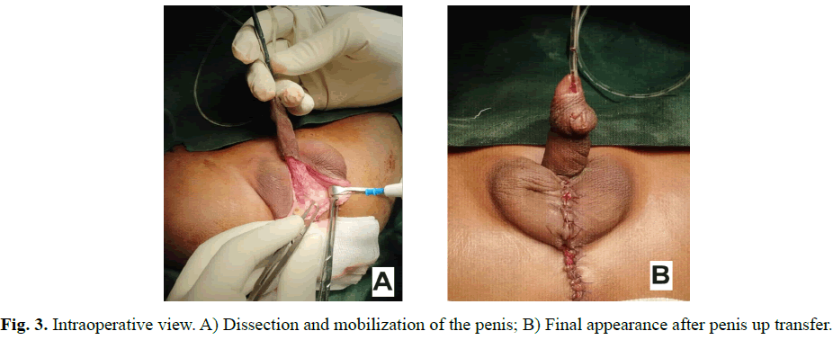 pediatricurology-distal-penis