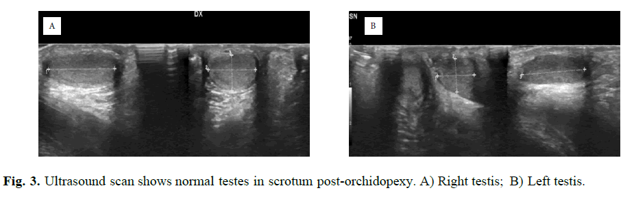 pediatricurology-distal-scrotum